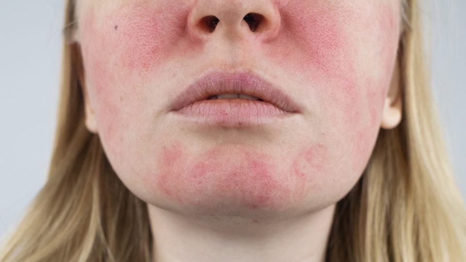 rosacea