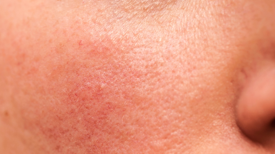 rosacea
