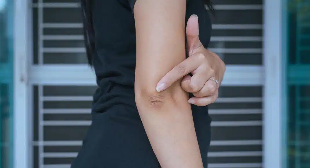SUHA KOŽA NA LAKTOVIMA OTKRIVA MNOGO VIŠE NEGO ŠTO MISLITE