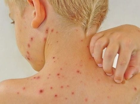 U Kantonu Sarajevo proglašena epidemija zarazne bolesti morbila
